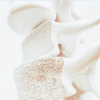 Osteoporosis vs. Osteopenia: What's the Difference?