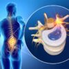 What Chiropractic Patients Want To Know About Herniated Discs