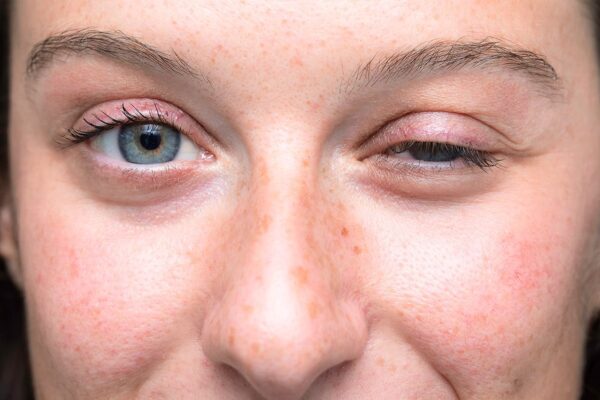 How Chiropractic Helps Patients Who Suffer From Myasthenia Gravis